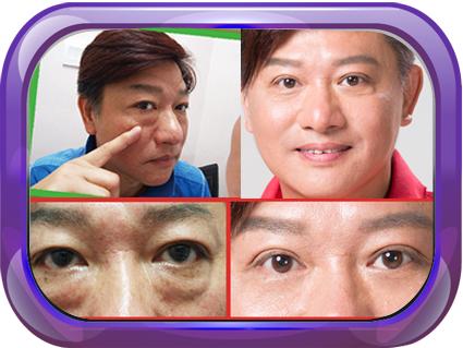 眼袋浮腫是什么原因