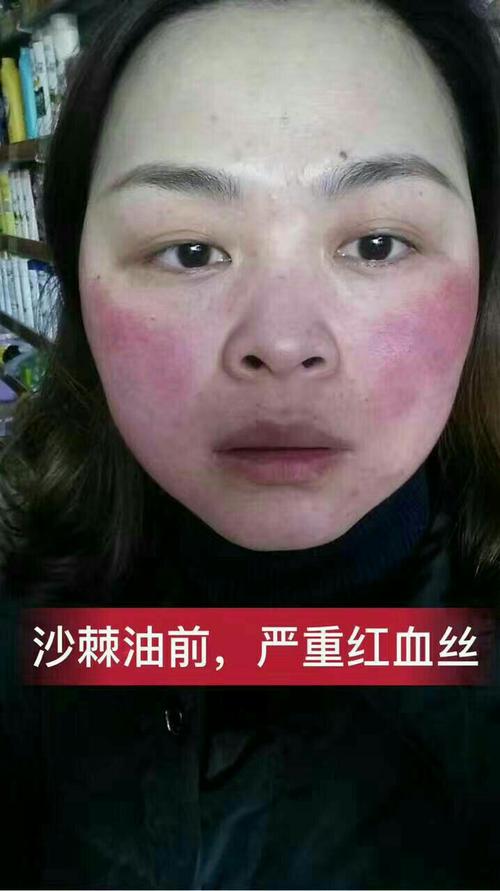 紅血絲的治療