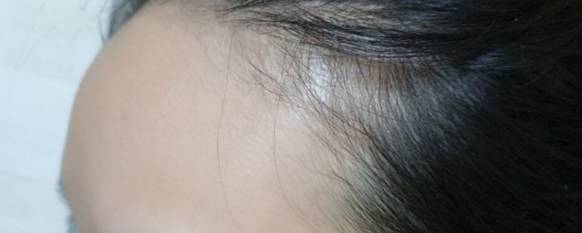 女生額頭高怎么辦