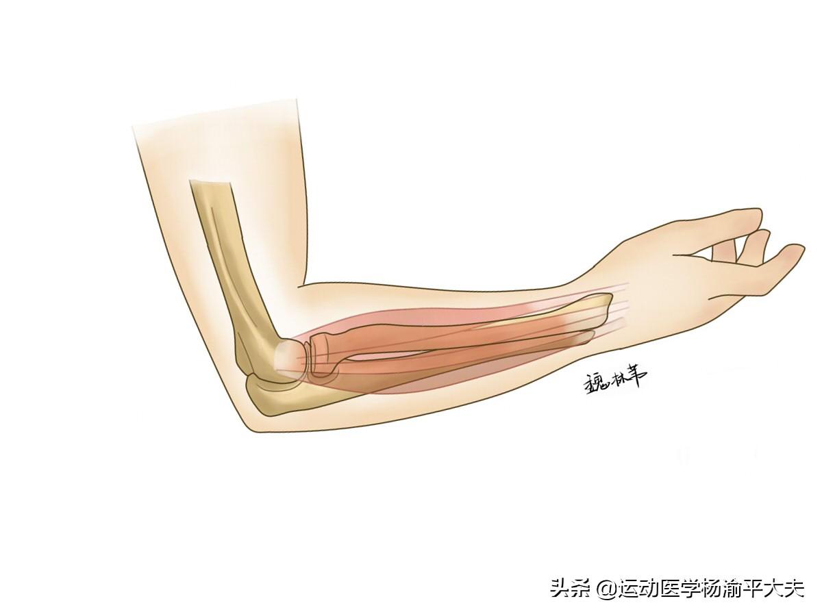 網球癥怎么治療最好（什么是治療網球肘有效辦法？這五個動作助你康復事半功倍）