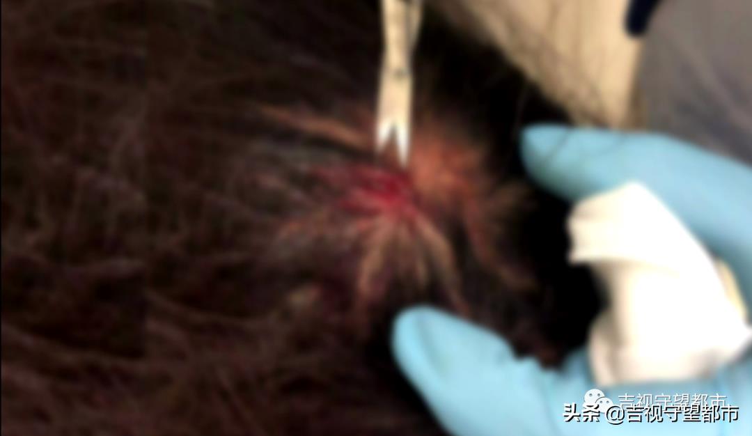 長春守望都市現(xiàn)場（今天上午，長春一行人被高空拋下酒瓶砸頭）
